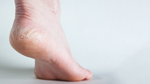 Apa Itu Kaki Kapalan, Ketahui Penyebabnya